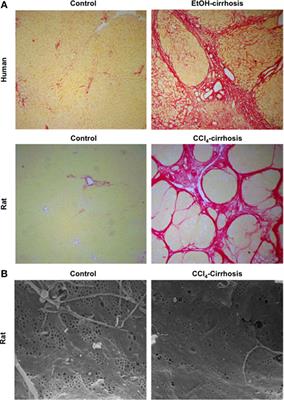 How to Face Chronic Liver Disease: The Sinusoidal Perspective